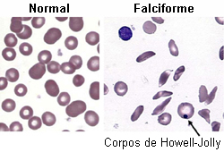 Anemia falciforme images