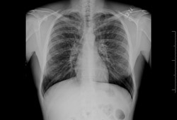 Bronchiectasis images