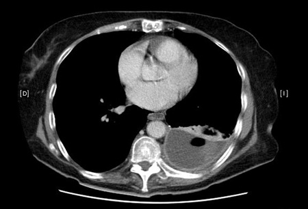 Empiema images
