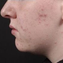 Acne vulgaris images