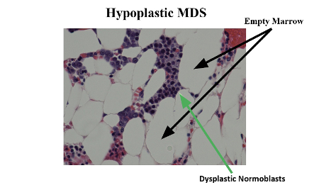 Assessment of pancytopenia images