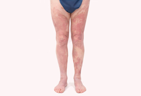 Cutaneous T-cell lymphoma images