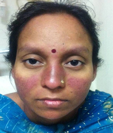 Lúpus eritematoso sistêmico images