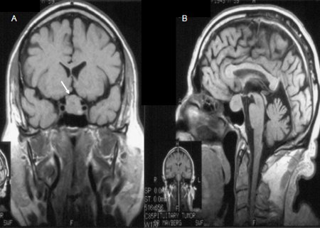 Pituitary adenoma images
