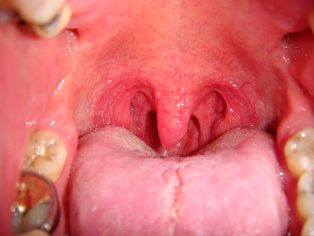 Snoring images