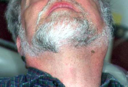 Sialadenitis images