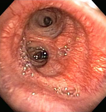 Evaluation of hemoptysis images