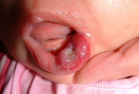 Haemangioma images