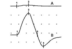 Síndrome miastênica de Lambert-Eaton images