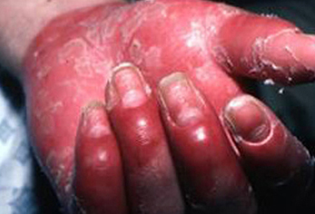 Assessment of seronegative arthritis images