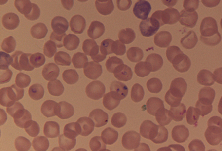 Babesiosis images