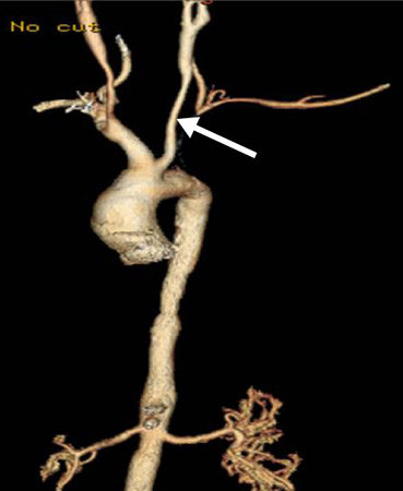 Takayasu's arteritis images