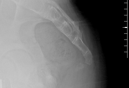 Coccigodinia images