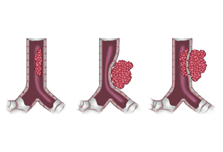 Central airway obstruction images