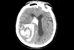 AVC hemorrágico images