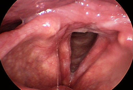 Paradoxical vocal fold motion (intermittent laryngeal obstruction) images