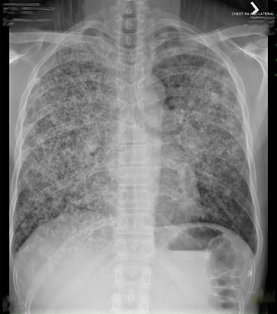 Evaluation of persistent pulmonary infiltrate images