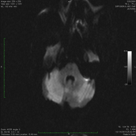 Assessment of ataxia images