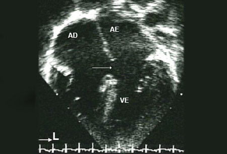 Comunicações interatriais (defeitos do septo atrial) images