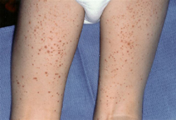 Vasculite de imunoglobulina A (púrpura de Henoch-Schönlein) images