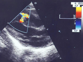 Ventricular septal defects images