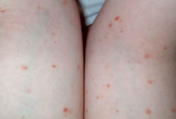 Pityriasis lichenoides images
