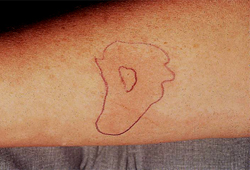 Asma ocupacional images