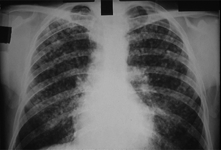 Neumoconiosis images