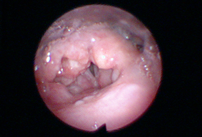 Laryngeal cancer images
