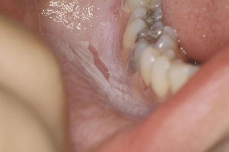 Evaluation of oral ulceration images