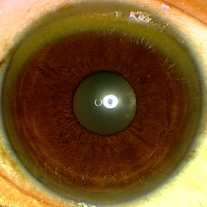 Assessment of liver dysfunction images
