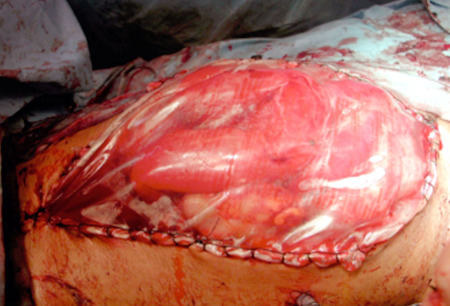 Abdominal compartment syndrome images