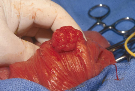 Peutz-Jeghers syndrome images