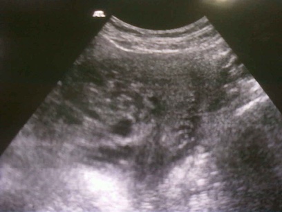 Molar pregnancies images