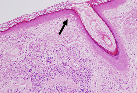 Discoid lupus erythematosus images