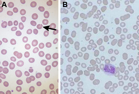 Hereditary spherocytosis images