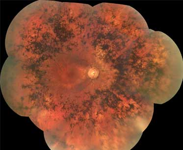 Retinite pigmentosa images