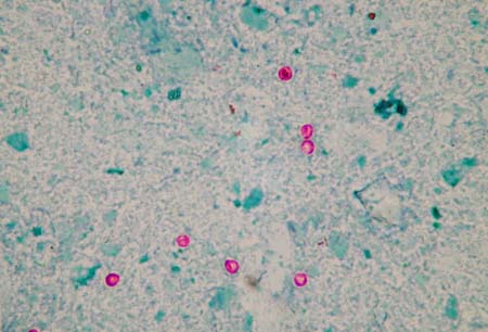 Cryptosporidiosis images