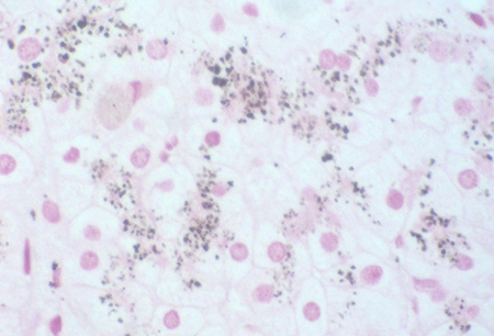 Dubin-Johnson syndrome images