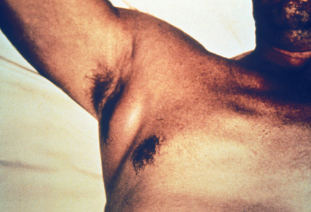 Yersinia infection images