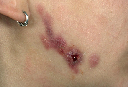 Actinomycosis images
