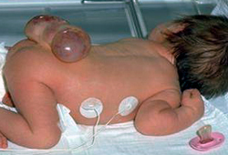 Spina bifida and neural tube defects images