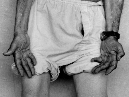 Charcot-Marie-Tooth disease images