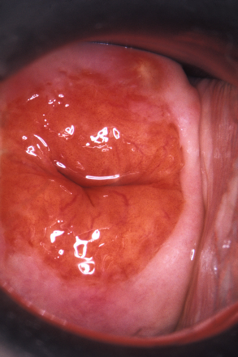 Assessment of vaginal bleeding images