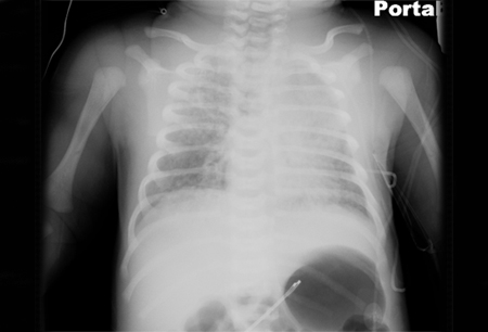 Meconium aspiration syndrome images