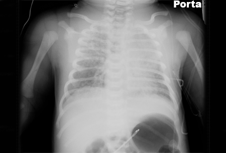 Síndrome de aspiración de meconio images