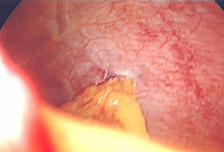 Assessment of abdominal trauma in adults images