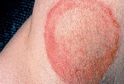 Infecções dermatofíticas images