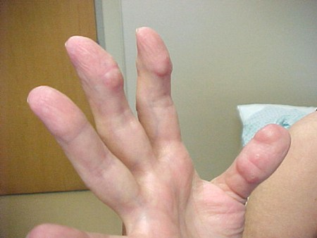 Assessment of inflamed joint images