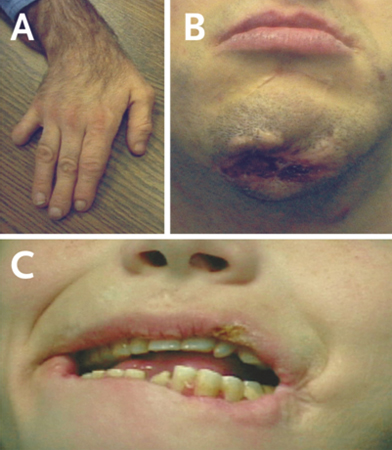 Lesch-Nyhan disease images